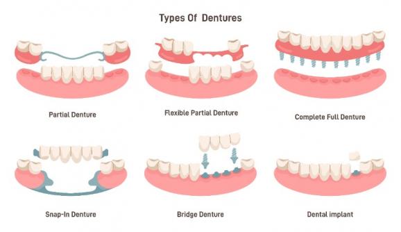 Solution en cas de perte de dents