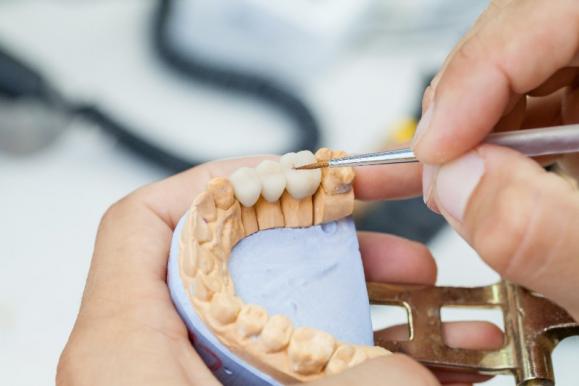 Prothèses dentaires sur-mesure